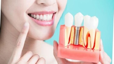 Diş İmplantları Hakkında Bilmeniz Gereken 9 Bilgi!