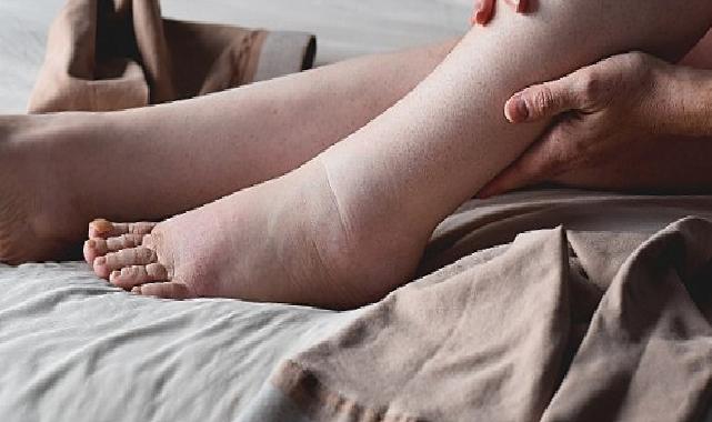 Lipödemli Bireylerde Anti-inflamatuar Diyet Ömür Kalitesini Artırıyor