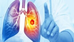 Her Yıl 25 Bin Akciğer Kanseri Hadisesi Önlenebilir
