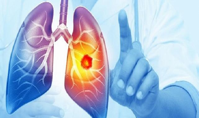 Her Yıl 25 Bin Akciğer Kanseri Hadisesi Önlenebilir