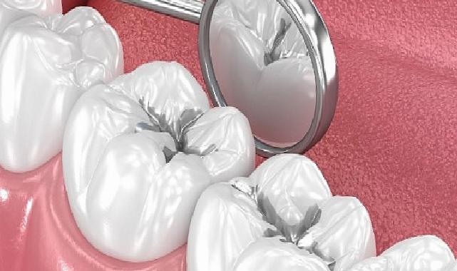 Amalgam Dolgular Değiştirilmeli mi?